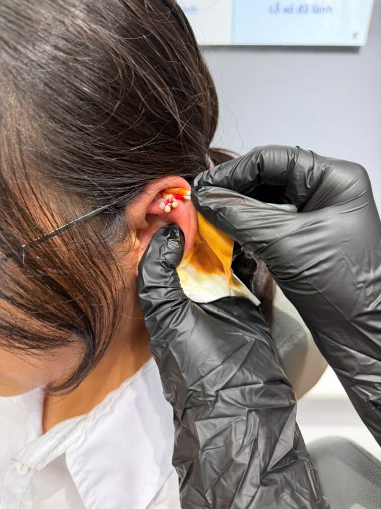 Bump Piercing Là Gì?