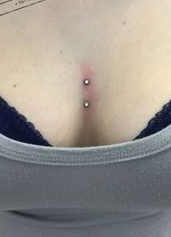 Rủi ro cao nhất: Surface piercing — ngực